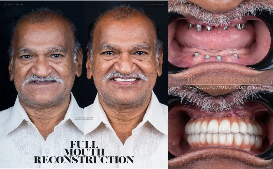 full mouth reconstruction at Dr. Jaydev Dental